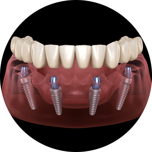 full arch dental implants