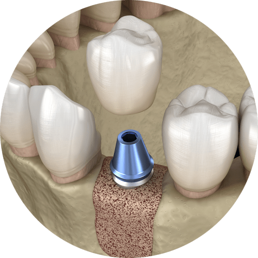 bone grafting model