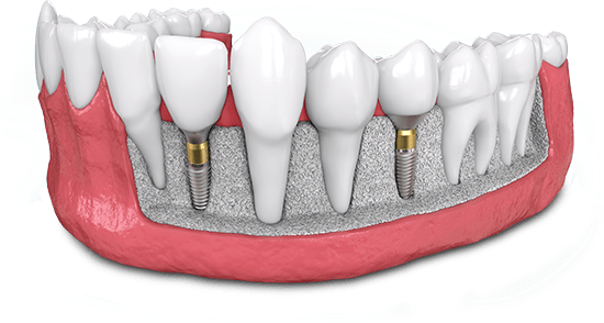 bone grafting model